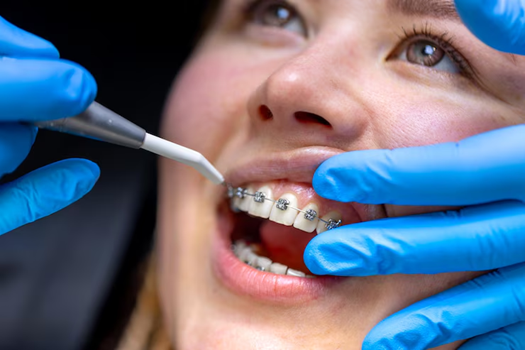 Common Myths About Orthodontic Treatment—Debunked!