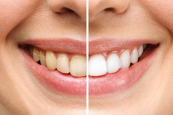 Teeth Whitening: How Technology Is Changing